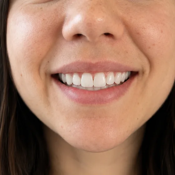 Sourire aux dents éclatantes après protocole