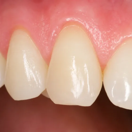 Gencives saines et dents nettes après