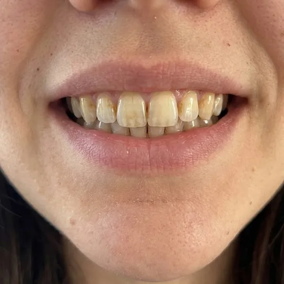 Sourire aux dents jaunies avant protocole